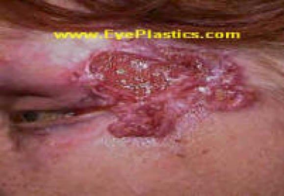 Basal cell carcinoma โ a pearly nodule with rolled borders and fine surface vessels