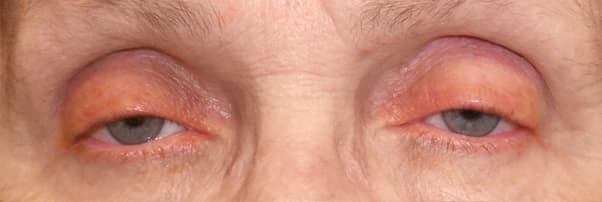 Both upper lids low in an older adult โ low margin, high crease