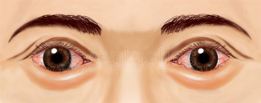 An image showing Entropion, a condition where the eyelid folds inward, causing irritation and discomfort.